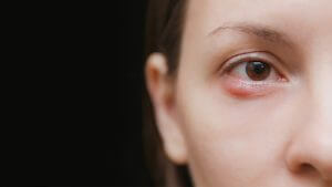 A close-up shot of a woman's eye with a stye.