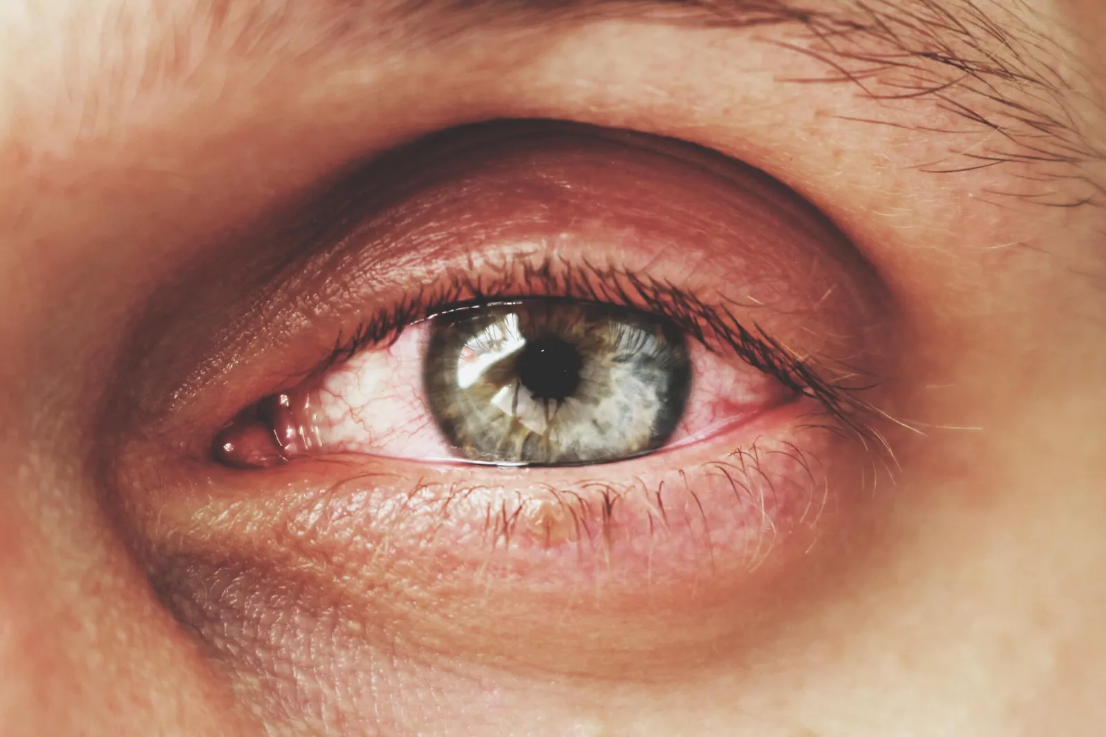 Eye diseases: Inflammation of the middle eye skin (uveitis)